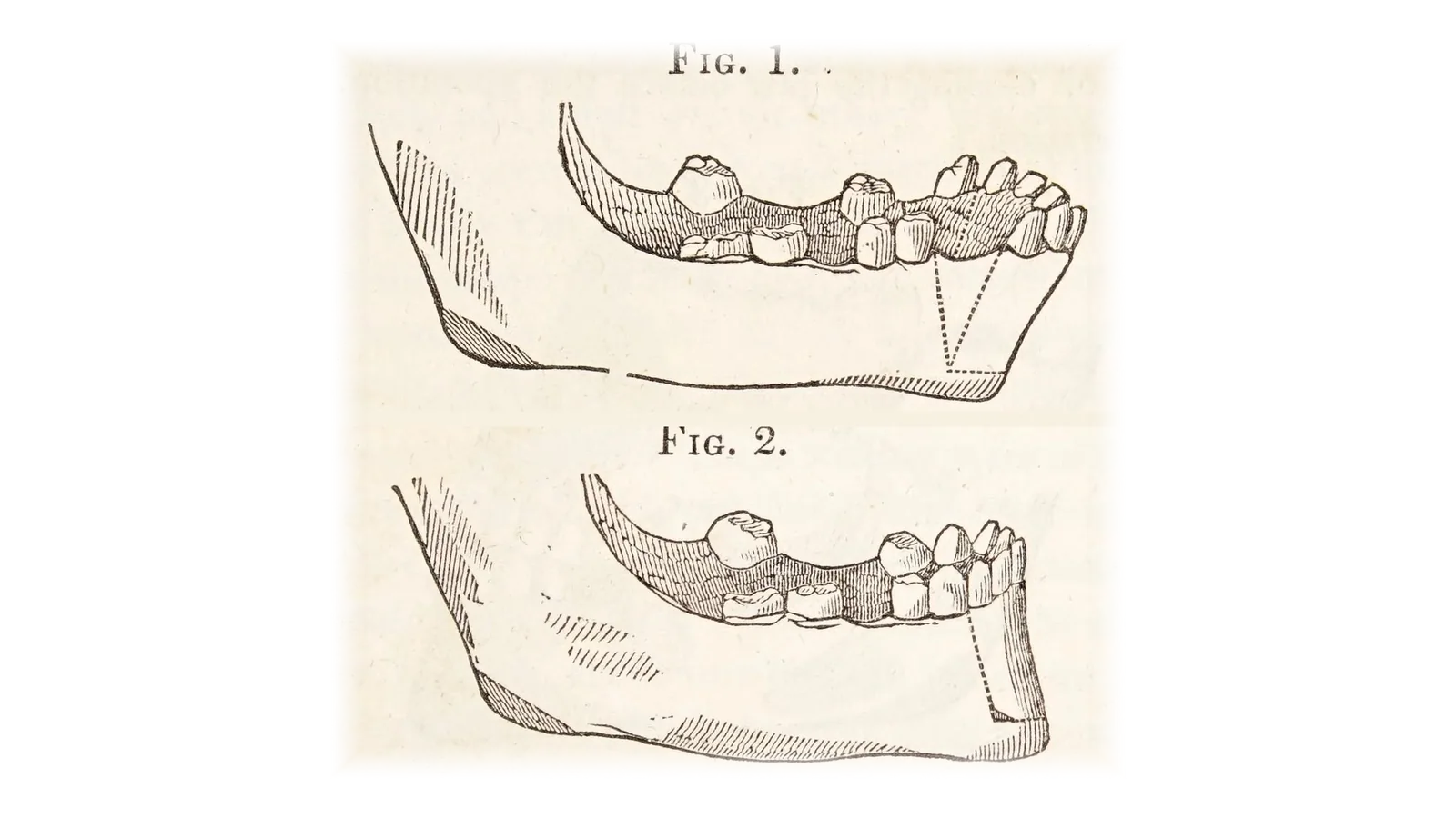 Hullihen, 1849: la primera osteotomía dentoalveolar publicada.
