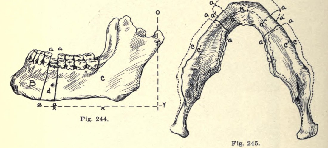 Comienzos del siglo XX: las primeras operaciones de la mandíbula se hacían en el cuerpo del hueso, retirando un segmento para corregir una mandíbula prominente. Se planificaban sobre modelos de yeso y radiografías.