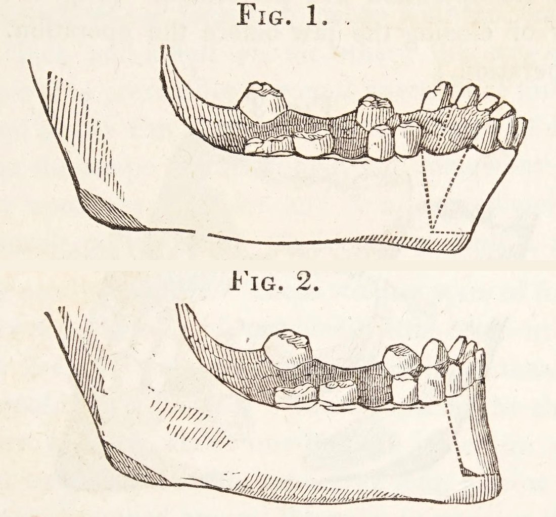 1849: Simon Hullihen publica la que se considera la primera cirugía ortognática. Cortó y llevó hacia atrás el segmento de la mandíbula que sostiene los seis dientes anteriores: una osteotomía dentoalveolar (figuras 1 y 2 del artículo original).